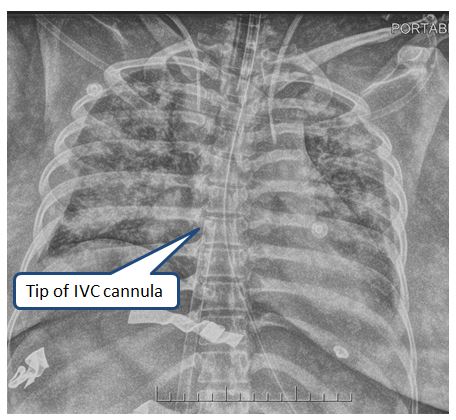 X-ray cannula placeement 4