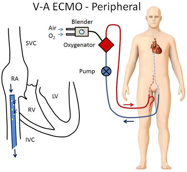 VA ECMO: Peripheral